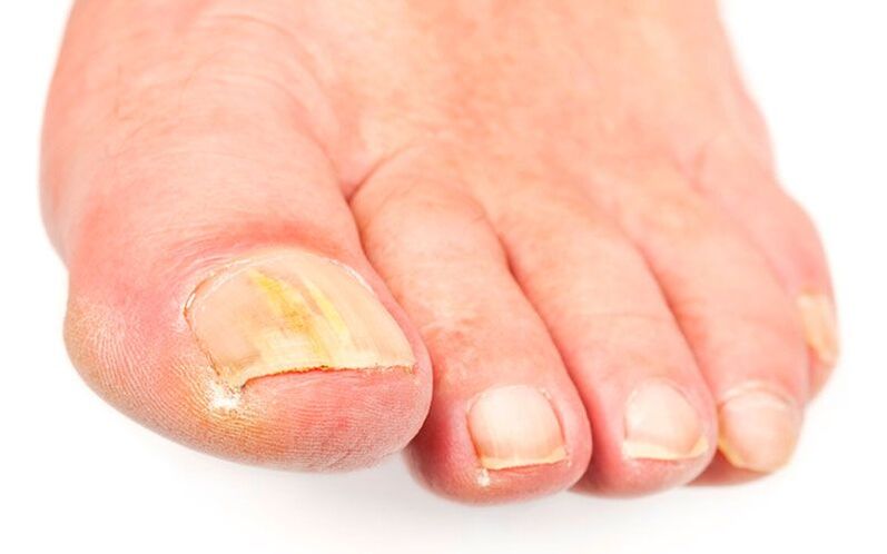 As causas do cogomelo