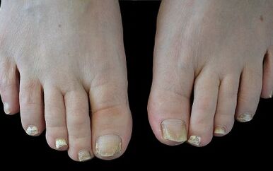 Como desfacerse do cogomelo nos dedos