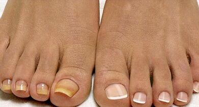 Métodos de tratamento de cogomelos de flota