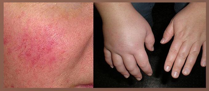 Efectos secundarios das pingas